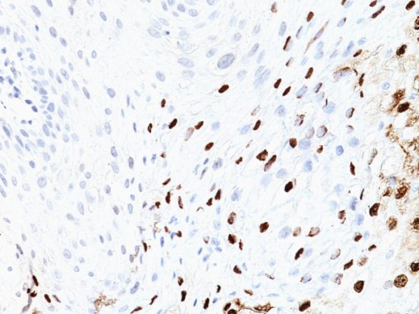 Formalin-fixed, paraffin-embedded human Cervix stained with HPV-16 Monoclonal Antibody (SPM405)