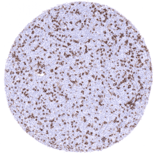 B-CLL containing CD4 positive lymphocytes.