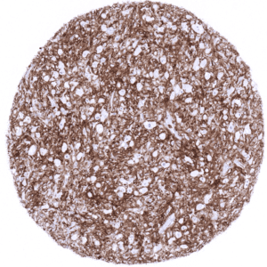 Dense infiltrate of CD4 positive macrophages and lymphocytes in a Hodgkin‘s Lymphoma.