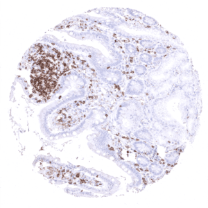 Numerous CD4 positive cells are seen in the mucosa of the duodenum.