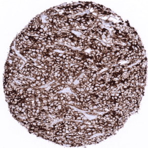 Large cell anaplastic T-cell lymphoma showing intense CD4 immunostaining of tumor cells.